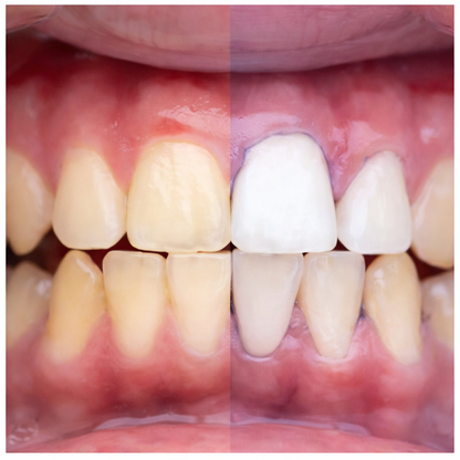 Blanqueador V34 Lumident®